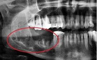 Доброкачественное образование – амелобластома челюсти: причины появления и правила лечения стоматологической опухоли
