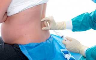 Болит спина после эпидуральной анестезии — что делать?