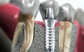 Какие бывают импланты для зубов производители и цены
