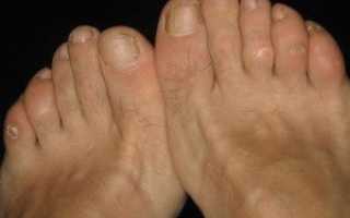 Шишка на среднем пальце ноги
