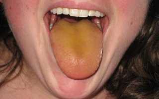 Желтый налет на языке чем лечить – простые средства