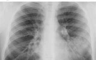 Микоплазма pneumoniae (пневмония) у взрослых, причины, симптомы и лечение