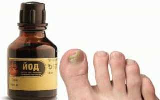 Лечение грибка ногтей ног в домашних условиях