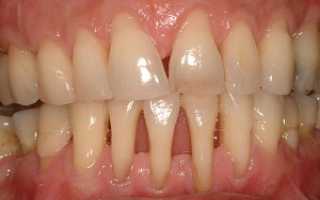Что такое пародонтит зубов? – подробно о методах лечения