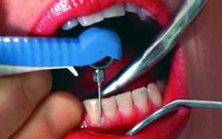 Основные причины возникновения и чистка зубов от зубного камня: цена эффективных стоматологических методик и процедур для удаления минерального налета