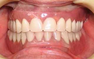 Методы протезирования зубов при отсутствии большого количества зубов: обзор съёмных и несъёмных конструкций
