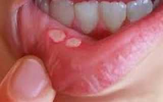 Зубы мудрости лечат или вырывать? – мнения стоматологов