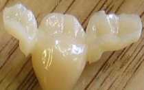Для замещения нескольких единиц зубного ряда – адгезивный мостовидный протез: особенности изготовления и установки