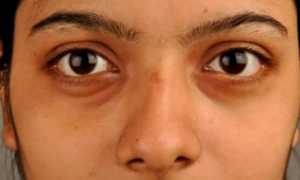 Желтые белки глаз: симптомы и причины появления желтушности склер, лечение