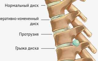 Как определить грыжу позвоночника?