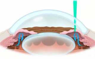 Иридэктомия: лазерная операция при глаукоме и восстановление в послеоперационный период