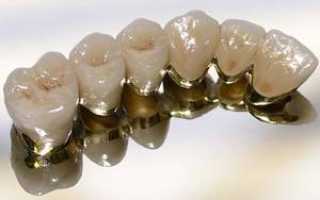 Протезирование зубов металлокерамическими коронками: плюсы и минусы изделий, техника и этапы установки