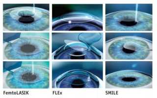 Лазерная коррекция зрения – противопоказания и ограничения при близорукости
