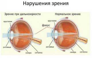 Гиперметропия – что это такое у детей, виды и степени дальнозоркости