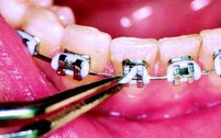 Современные ортодонтические конструкции – скобы для зубов: принцип действия, особенности установки и использования
