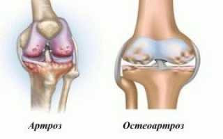 Артроз и остеоартроз