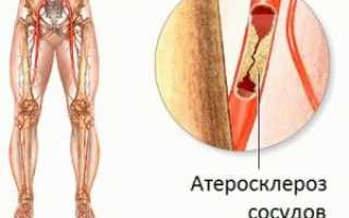 Атеросклероз нижних конечностей в старческом возрасте