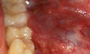 Воспаление слюнных желез лечение таблетки какие лучше – советы стоматолога