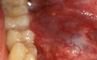 Воспаление слюнных желез лечение таблетки какие лучше – советы стоматолога