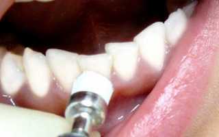 Нюансы и правила проведения ультразвуковой чистки зубов: фото до и после процедуры, показания к проведению и результат