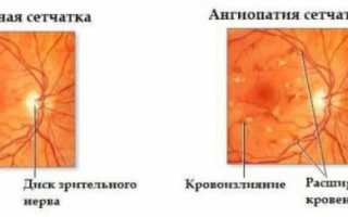 Гипертоническая ангиопатия сетчатки: диагностика и методы лечения