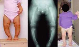 Вальгусное искривление ног у ребёнка
