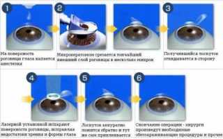 ФРК операция на глаза: метод проведения лазерной коррекции и восстановления после процедуры