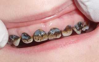 Серебрение зубов препарат – суть и правила проведения процедуры