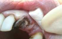 Как быть и что делать, если зуб сломался под корень: методы реставрации и процедуры для восстановления зубной единицы