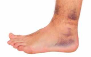 Болезни ног у людей и их лечение