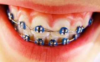 Как исправить дефекты зубного ряда с помощью брекетов: стоимость и установка, преимущества и особенности ортодонтических конструций