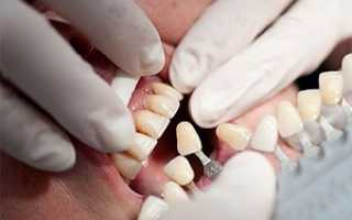 Особенности процедуры наращивания зубов: фото до и после, методики и результат восстановления зубного ряда