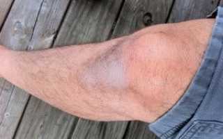 Почему колени хрустят и болят
