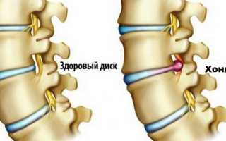 Лечение хондроза шейно грудного отдела позвоночника