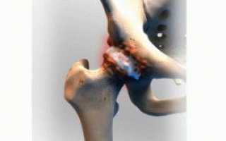 Реактивный артрит тазобедренного сустава у детей