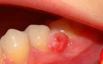 Как лечить кисту на зубе? – практические советы стоматолога