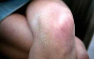 Почему опухло колено без ушиба и болит