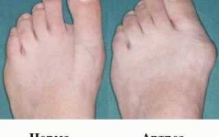 Артроз плюснефалангового сустава первого пальца стопы