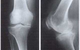 Остеоартроз коленного сустава 3 степени