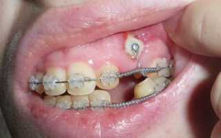Чем опасен ретинированный зуб и что это такое? Методы лечения и удаления не прорезавшихся зубных единиц
