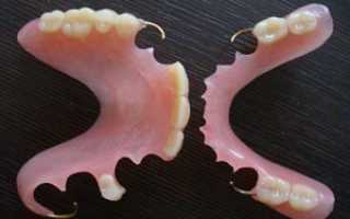 Как подобрать съемные зубные протезы при частичном отсутствии зубов: фото и характеристика, разновидности конструкций