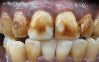 Почему возникает и как развивается флюороз зубов: фото заболевания, симптоматика и правила лечения