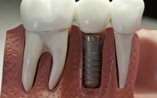 Как проводится процедура и как ставят зубные импланты или что необходимо знать при вживлении искусственных зубов