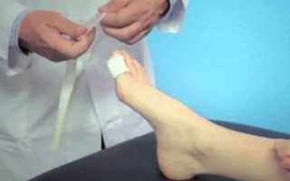 Воспаление ногтевого валика на ноге